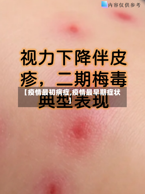 【疫情最初病症,疫情最早期症状】-第1张图片