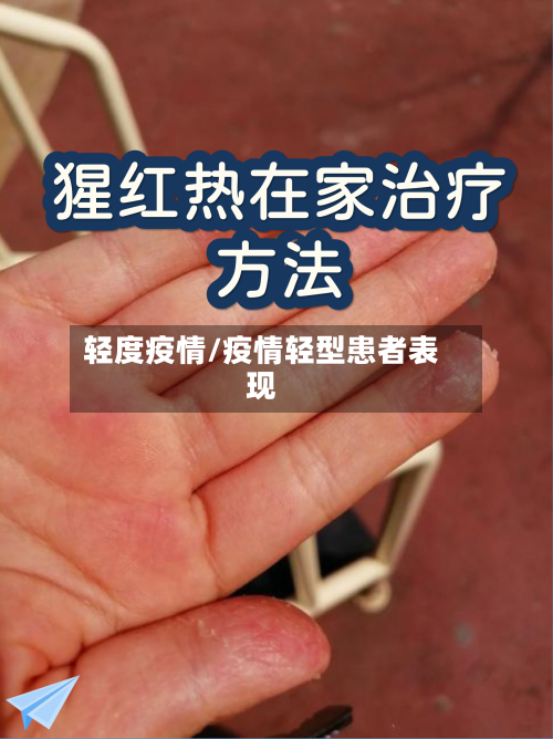 轻度疫情/疫情轻型患者表现-第1张图片