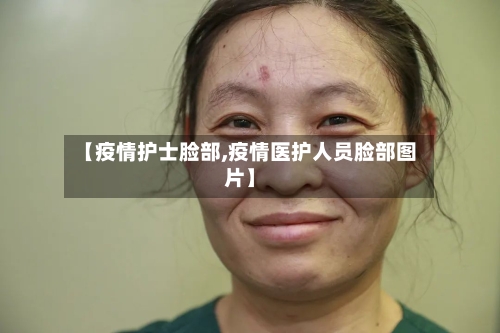 【疫情护士脸部,疫情医护人员脸部图片】-第1张图片